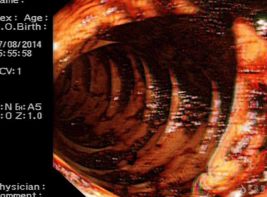 09日全麻下行剖腹探查术,术中见:肿瘤位于空肠对系膜处距离屈氏韧带约