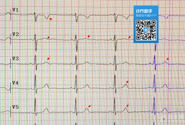 心电图等电位线是死了图片
