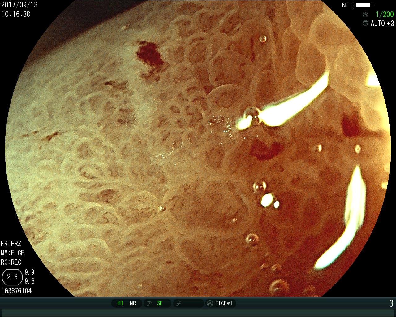胃癌图片实拍 早期图片