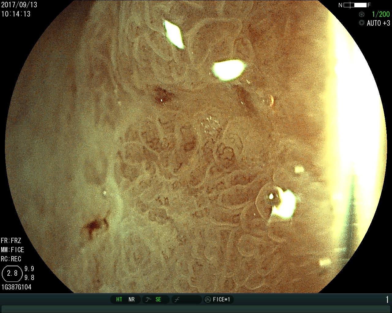 早期胃癌的放大胃镜图片