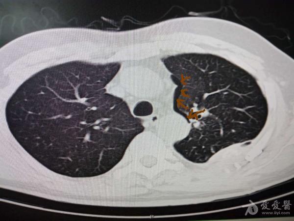 患者出院  由于患者咳嗽剧烈导致肺泡破裂空气沿肺血管周围进入纵隔