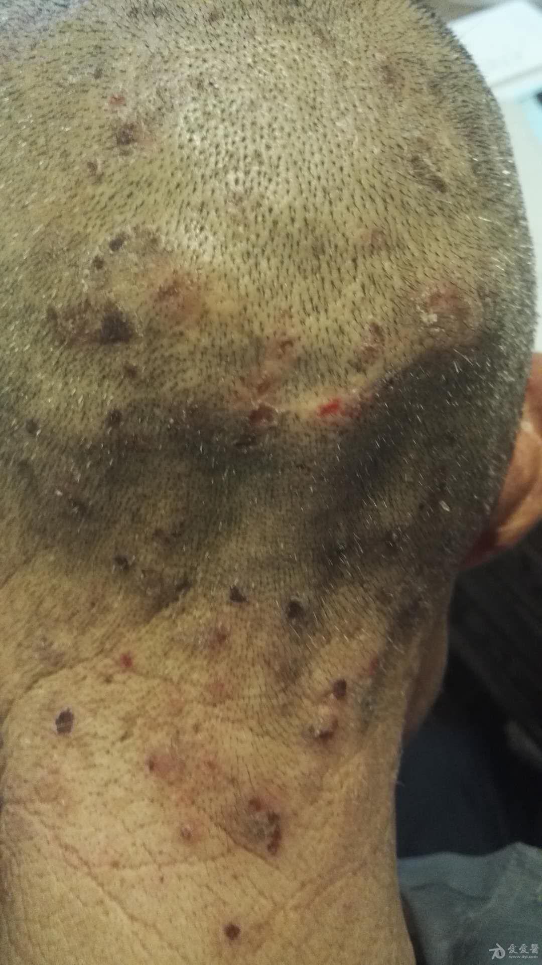 请问这是啥皮肤病?怎么治疗?