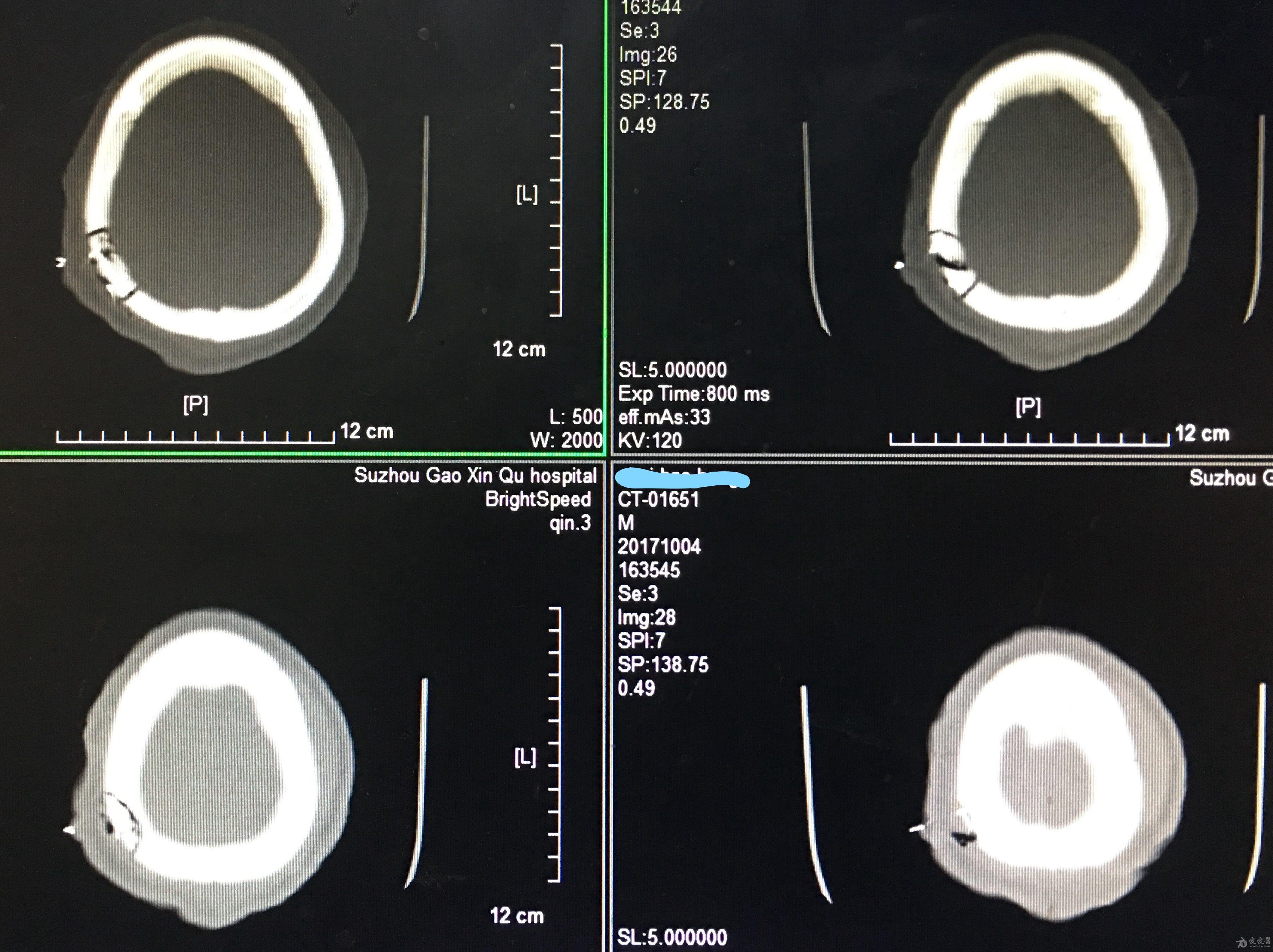 分享頂骨凹陷性骨折整復術1例