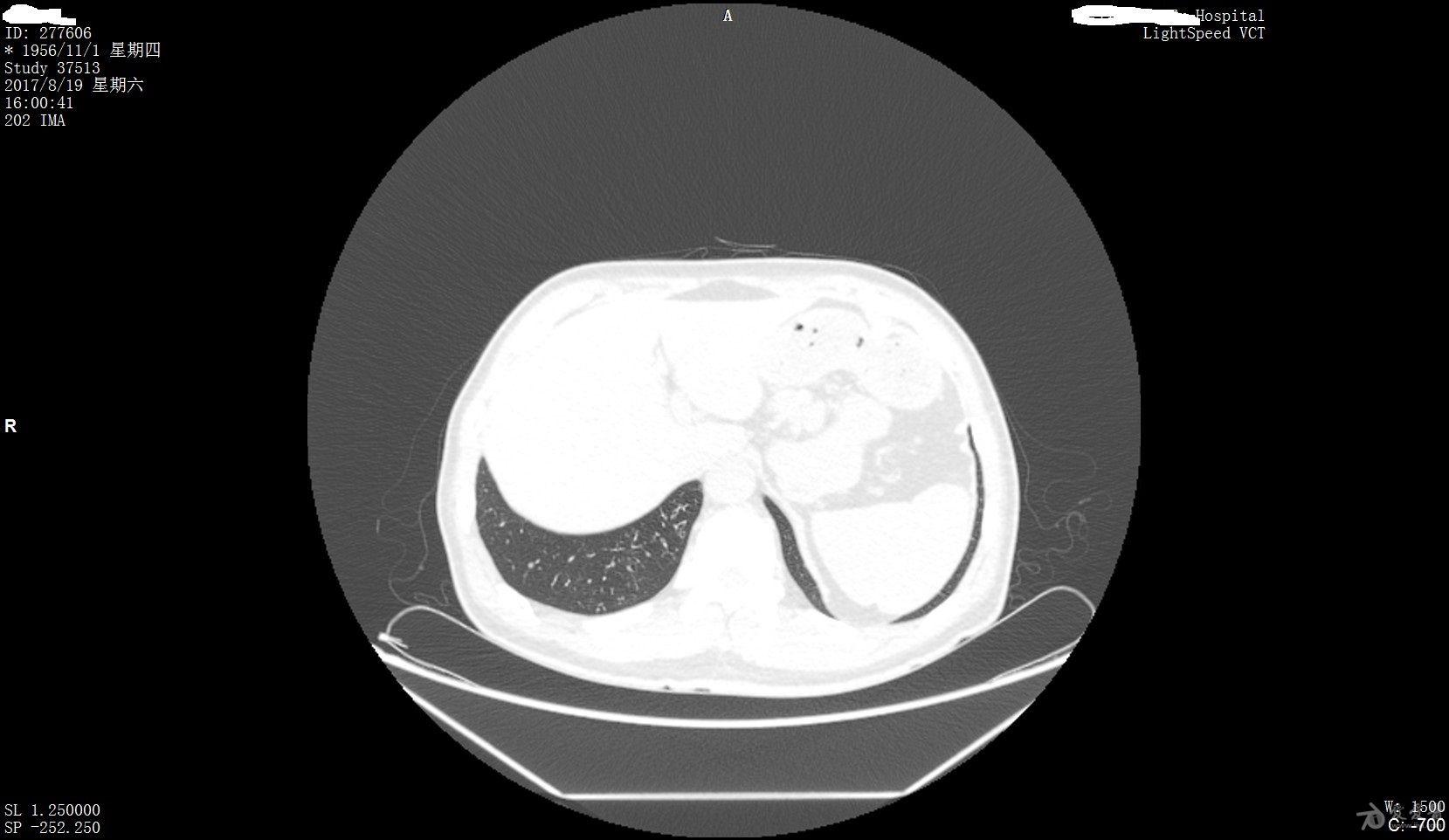 先天性胸腹裂孔疝图片