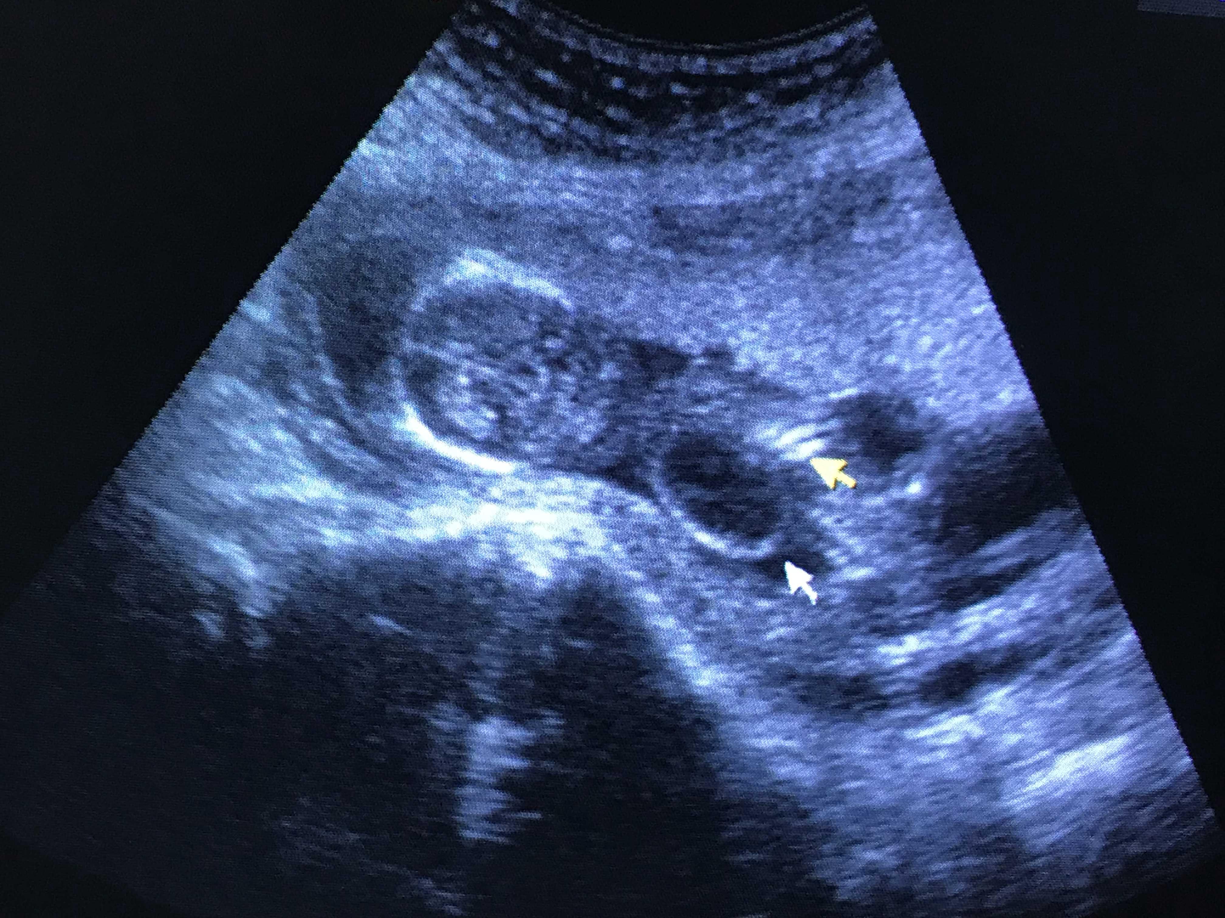 临床检查区 69 超声医学讨论版 69 各位老师们,请帮忙看看胎儿