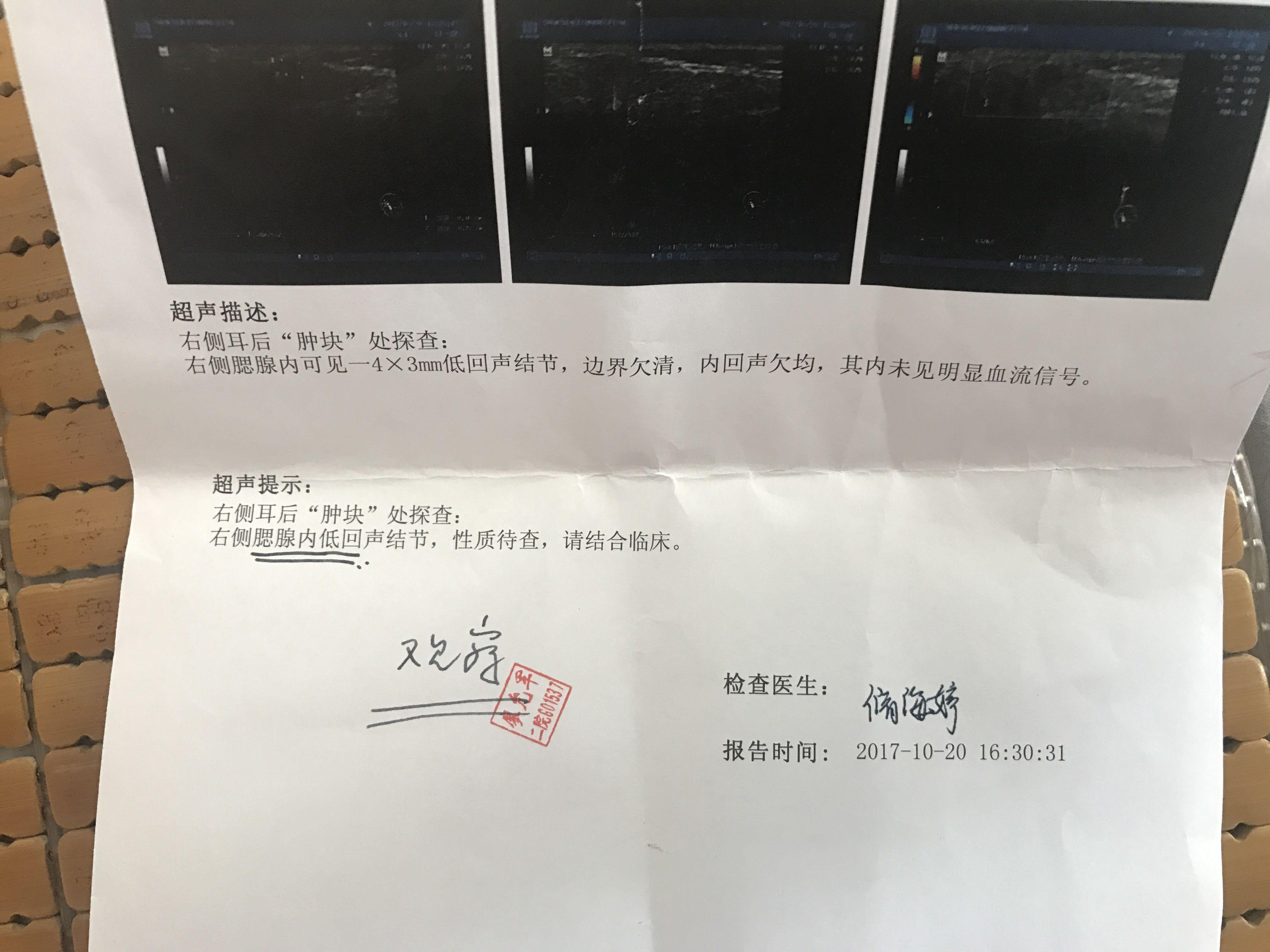 急性腮腺炎的超声图片图片