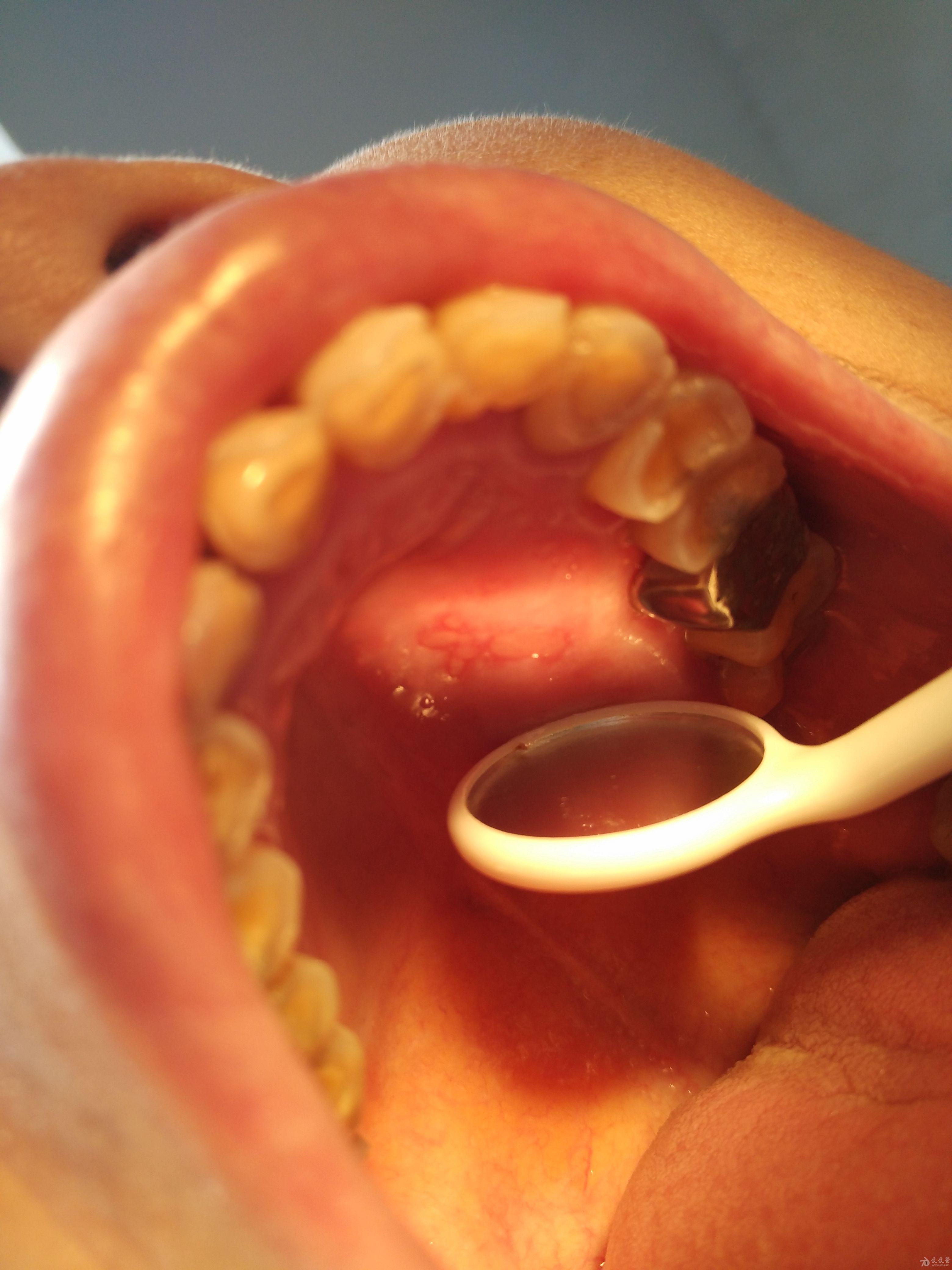 病例讨论-打麻药之后粘膜出现的问题 - 口腔医学专业讨论版 - 爱爱医