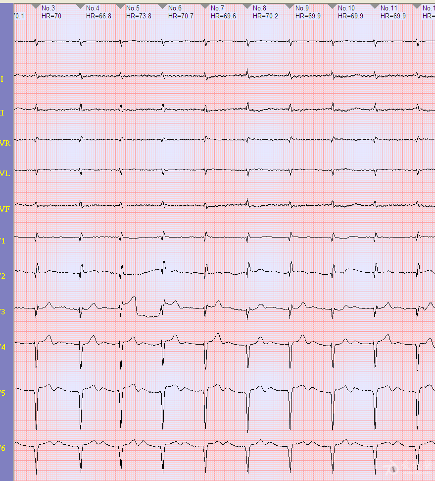 风湿性心脏病心电图图片