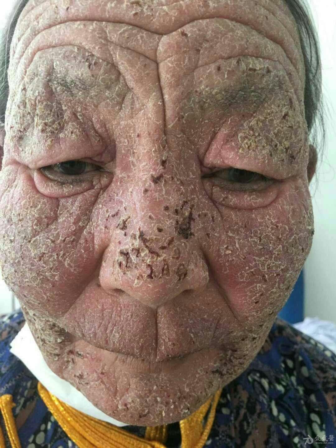 有奖猜图积分大派送258慢性光化性皮炎