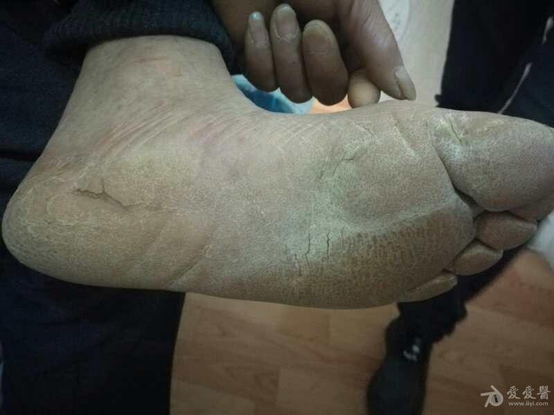 有奖猜图积分大派送260掌跖角化病