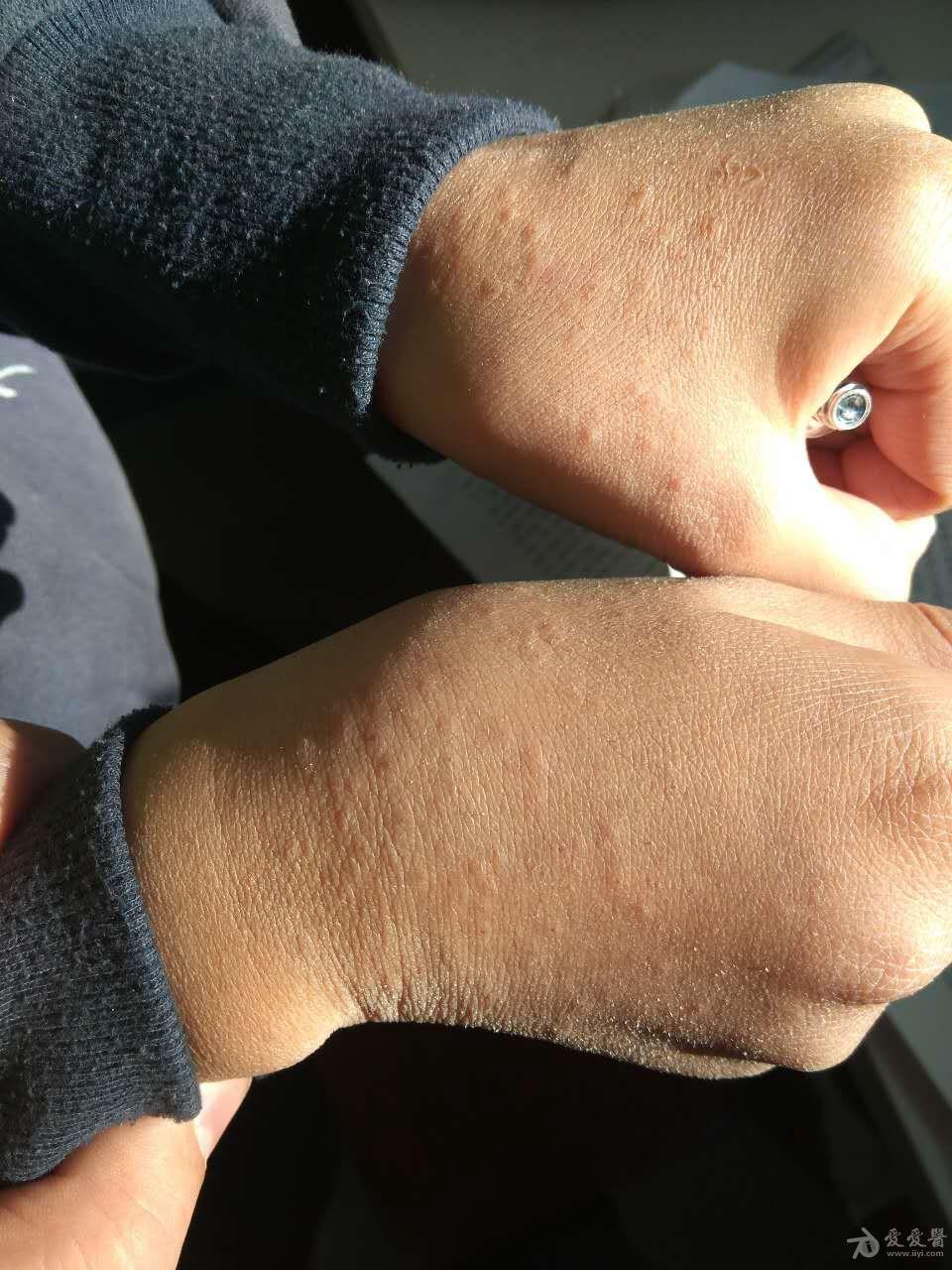 孩子手上起了好多小疙瘩