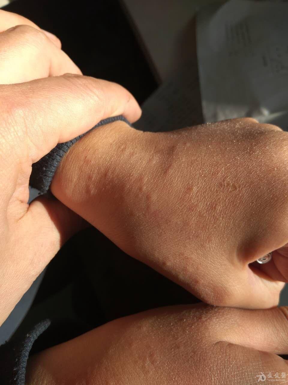 孩子手上起了好多小疙瘩