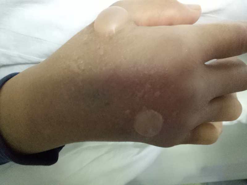 造影剂外渗,如何处理?