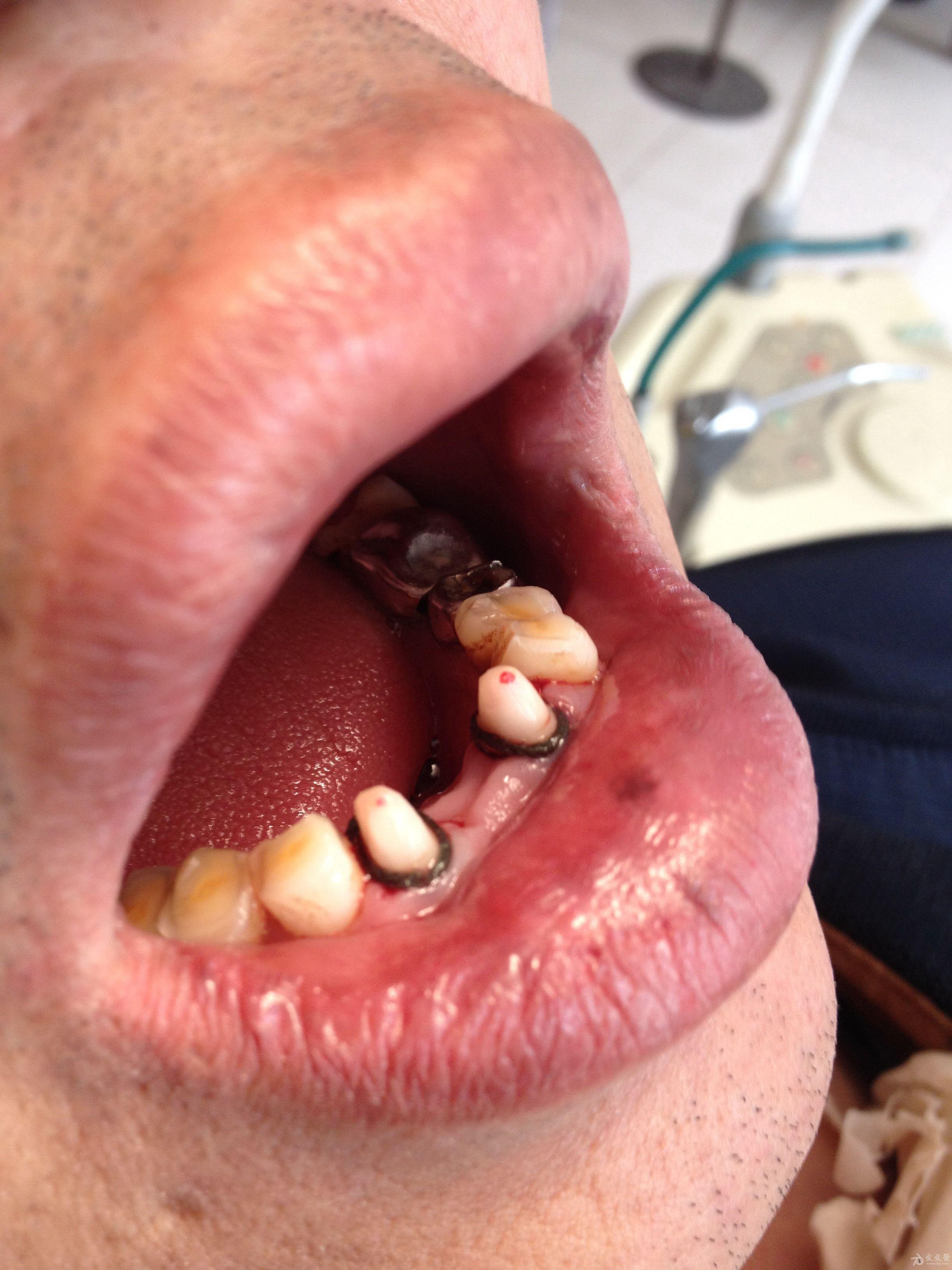 元旦病例下前牙牙体预备穿髓