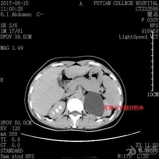 元旦病例超声诊断左肾双肾盂双输尿管畸形伴其一输尿管异位开口一例