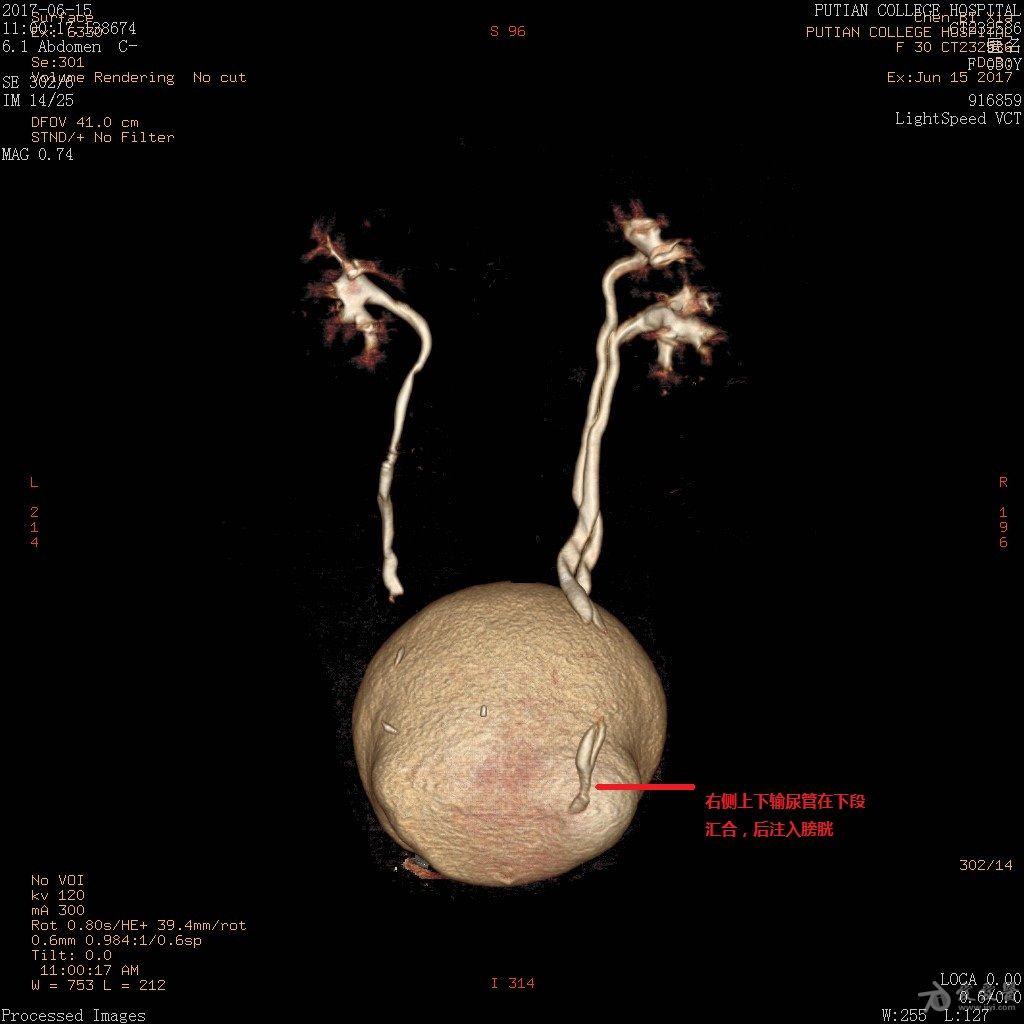 元旦病例超声诊断左肾双肾盂双输尿管畸形伴其一输尿管异位开口一例