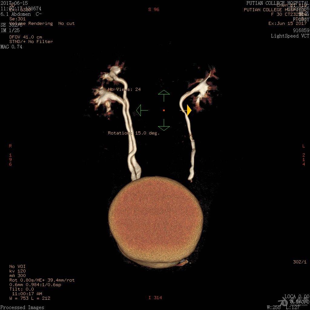 元旦病例超声诊断左肾双肾盂双输尿管畸形伴其一输尿管异位开口一例