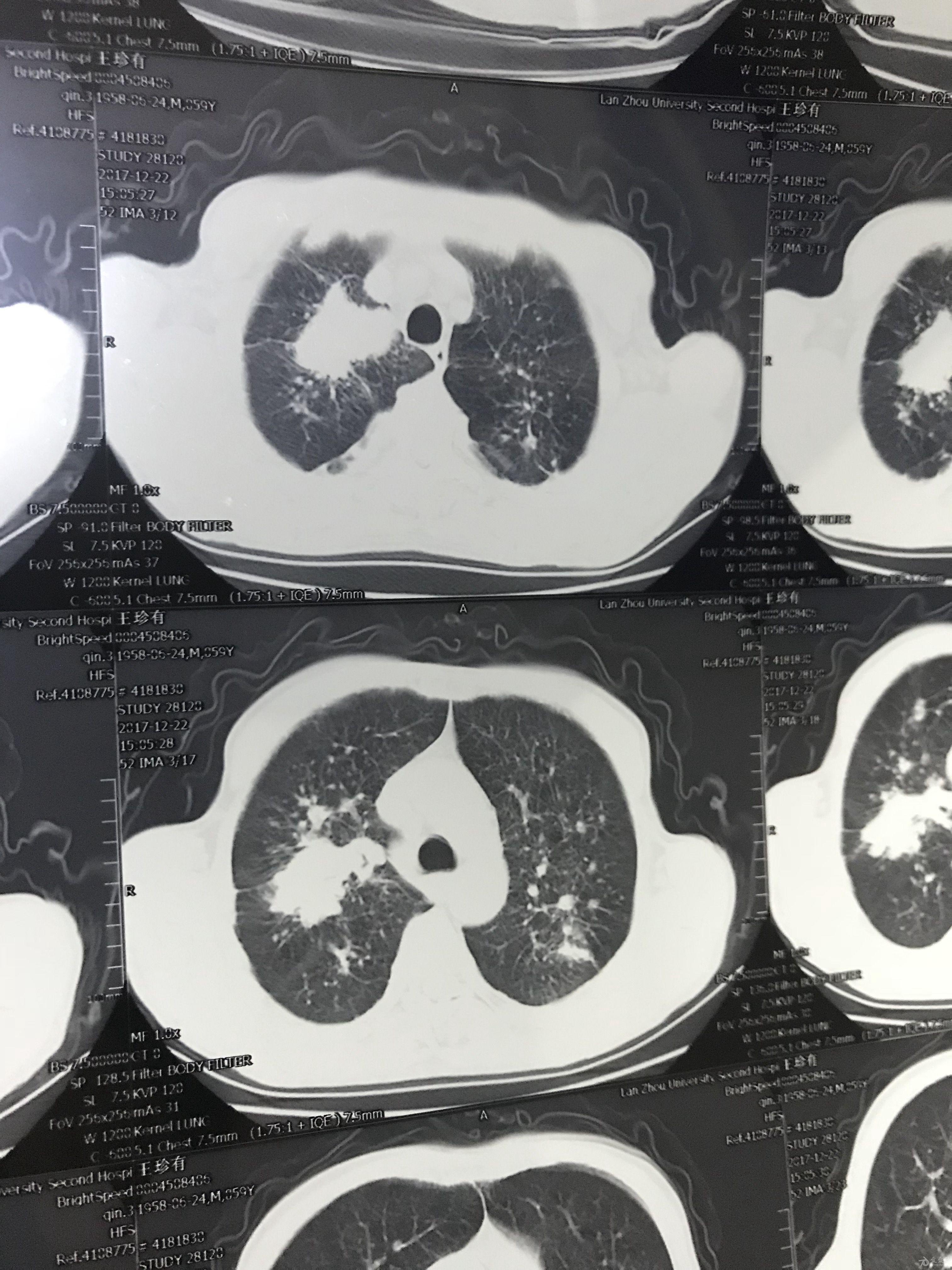 诊断ct,是否是肺癌