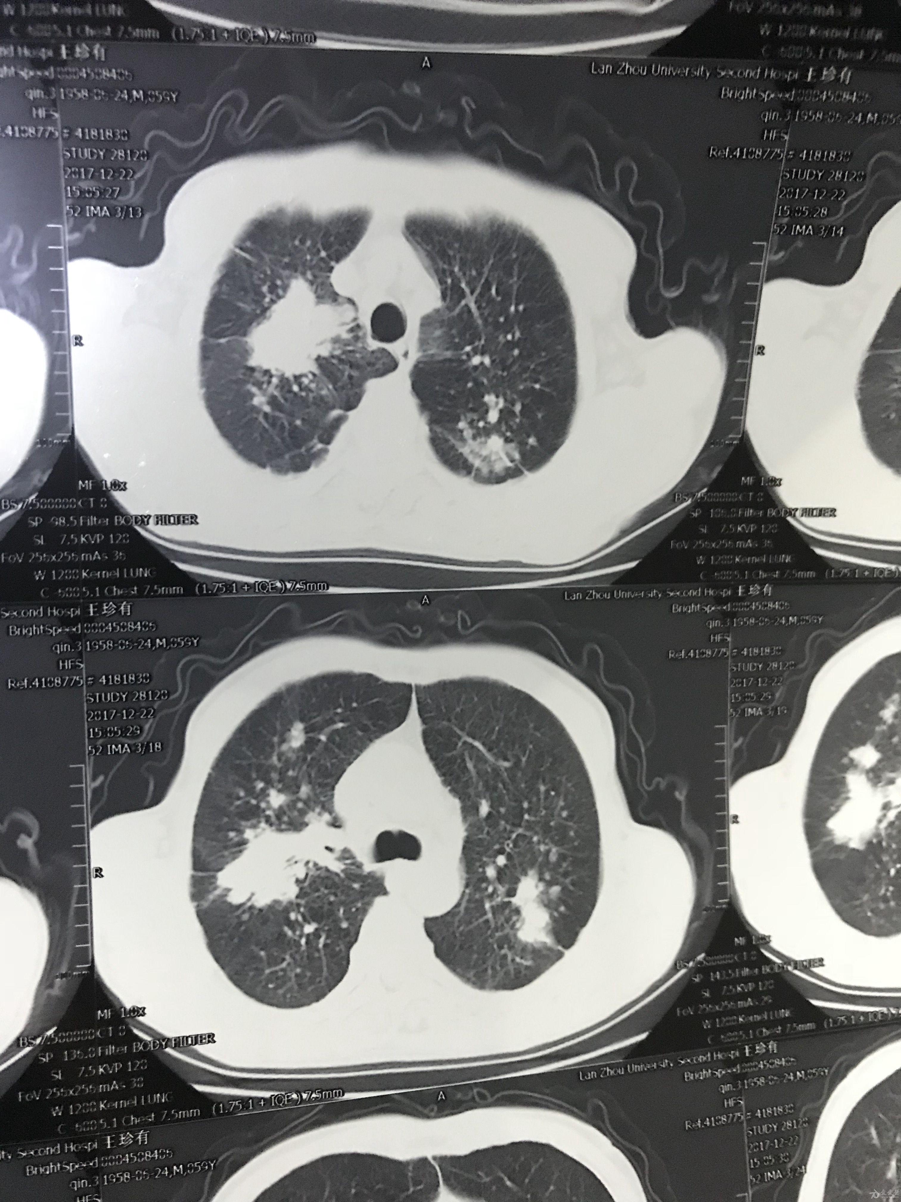 肺癌增强ct图片