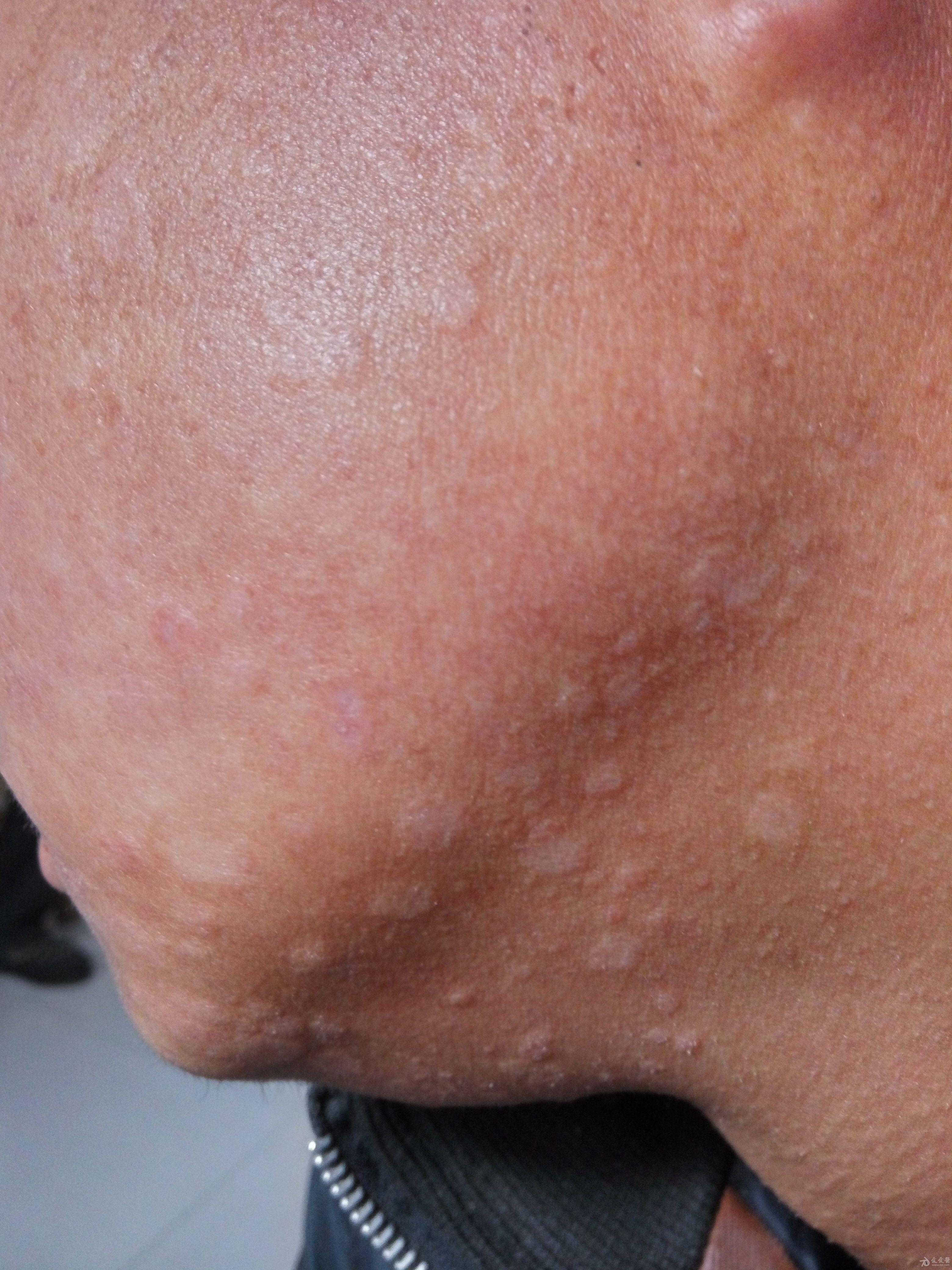 面部皮损半月是何皮肤病