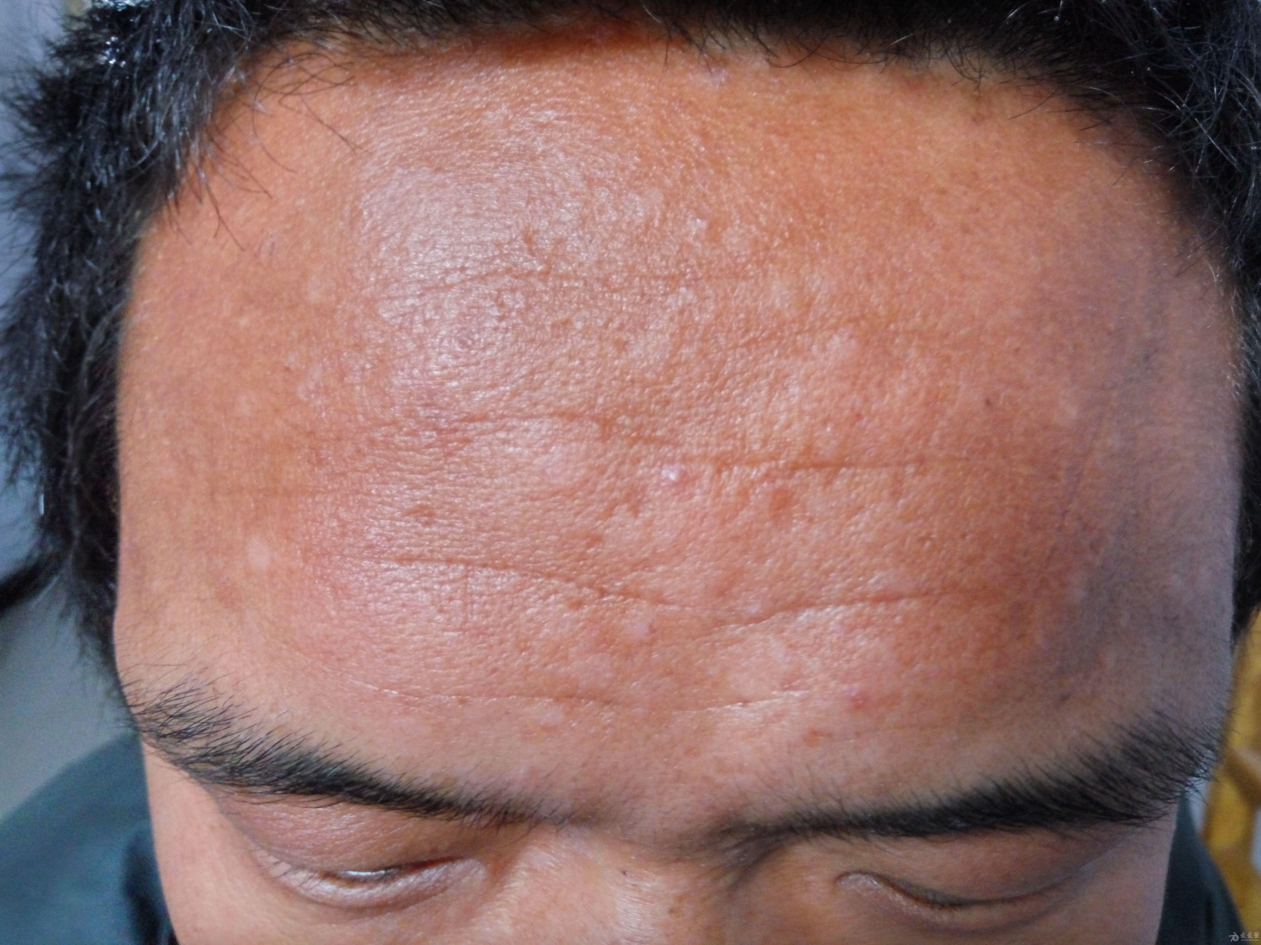 面部皮损半月是何皮肤病