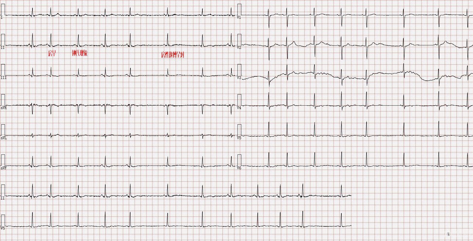窦性心律边缘心电图图片