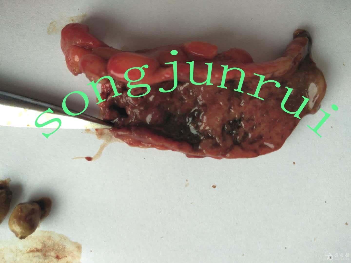 超声入门贴695急性化脓性阑尾炎并腔内粪石穿孔周围脓肿形成手术标本