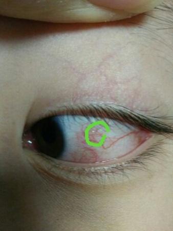 左眼球结膜充血有泡1