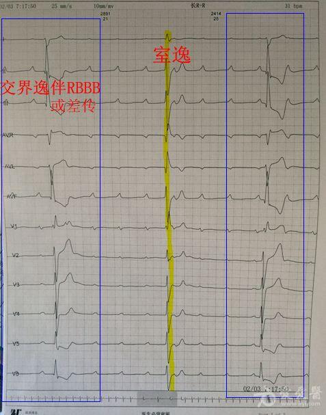 是高度房室传导阻滞吗