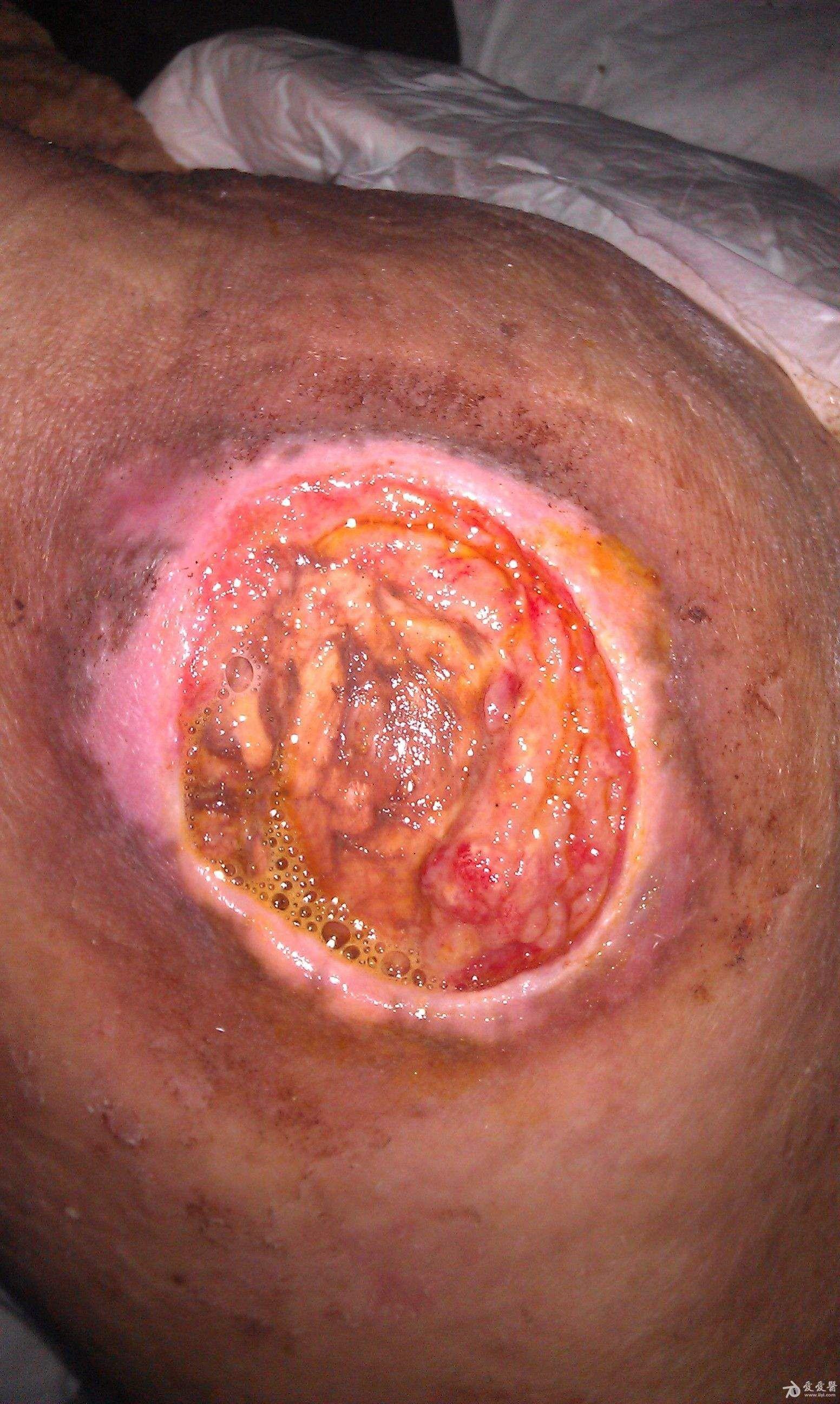 每一天学一点活动77褥疮的预防和护理