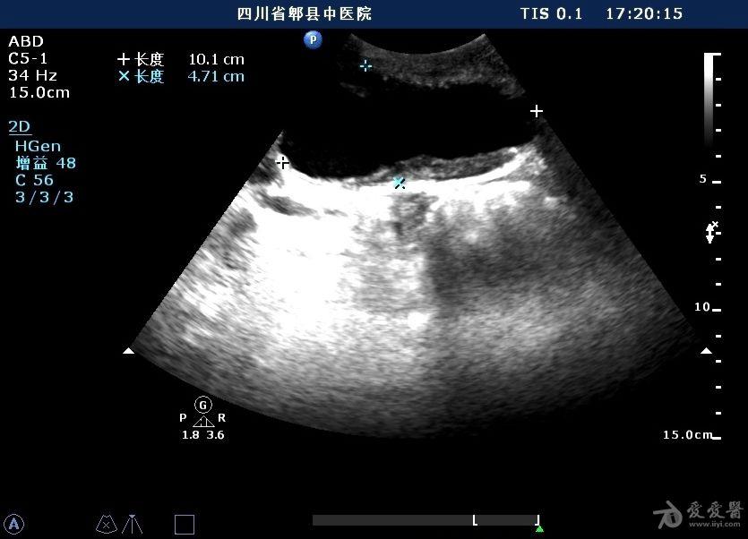 腹主动脉瘤伴瘤壁粥样硬化斑块形成 