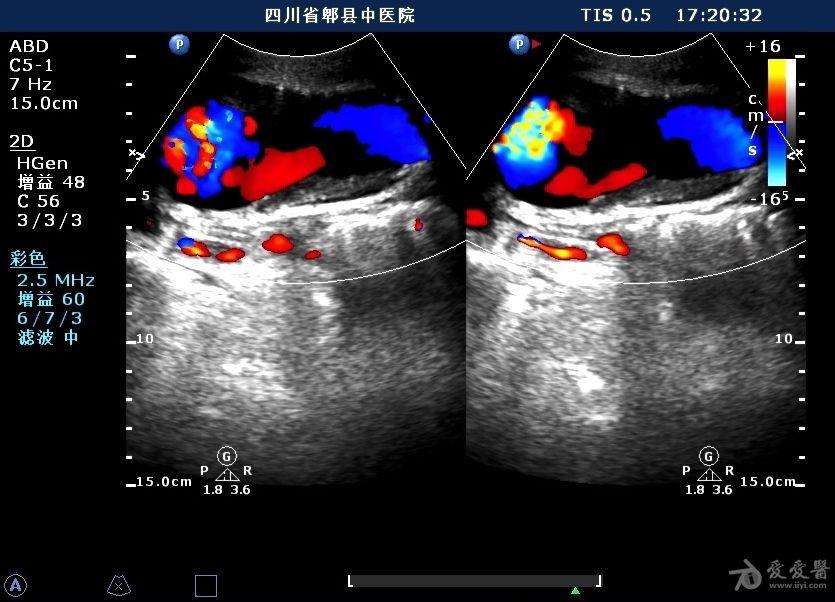 腹主动脉瘤伴瘤壁粥样硬化斑块形成 