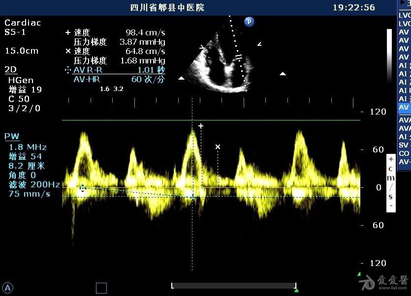 房间隔缺损之卵圆孔未闭 - 超声医学讨论版 - 爱爱医医学论坛