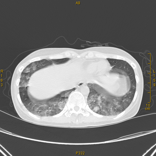 病例68——肺部典型病例(吸入性肺炎) - 医学影像学讨论版 - 爱爱医