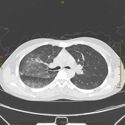 病例68——肺部典型病例(吸入性肺炎)