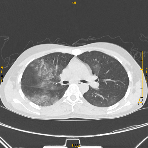 病例68肺部典型病例吸入性肺炎