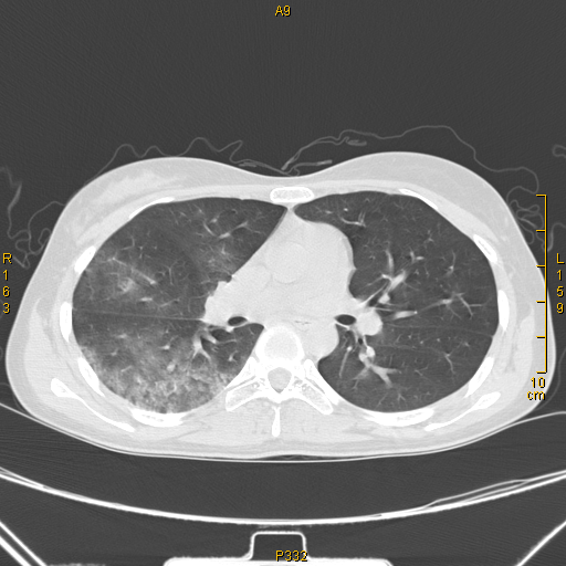 病例68肺部典型病例吸入性肺炎