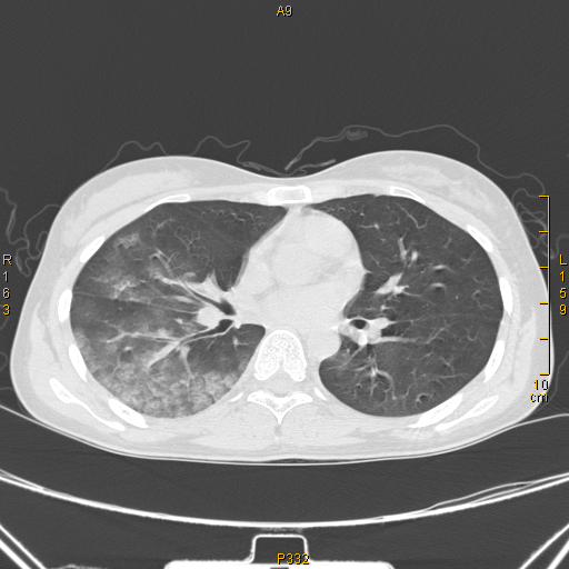 病例68——肺部典型病例(吸入性肺炎)