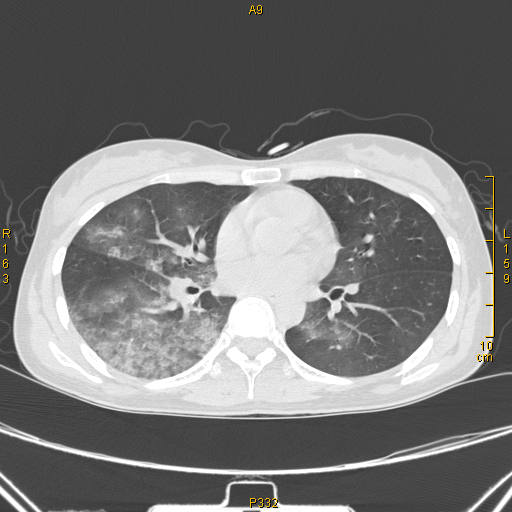 病例68——肺部典型病例(吸入性肺炎) 
