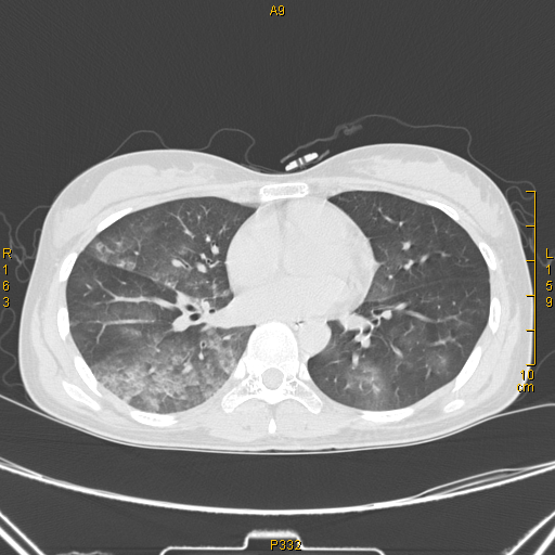 病例68——肺部典型病例(吸入性肺炎) - 医学影像学讨论版 - 爱爱医