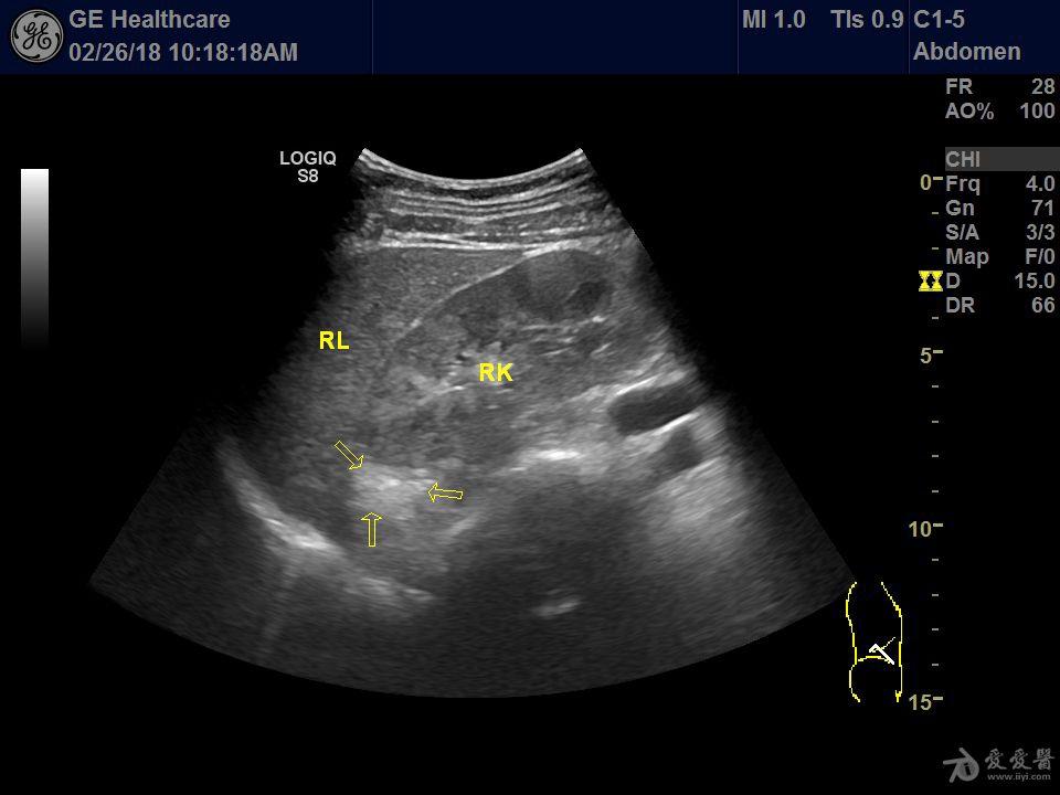 正常右肾上腺 - 超声医学讨论版 - 爱爱医医学论坛