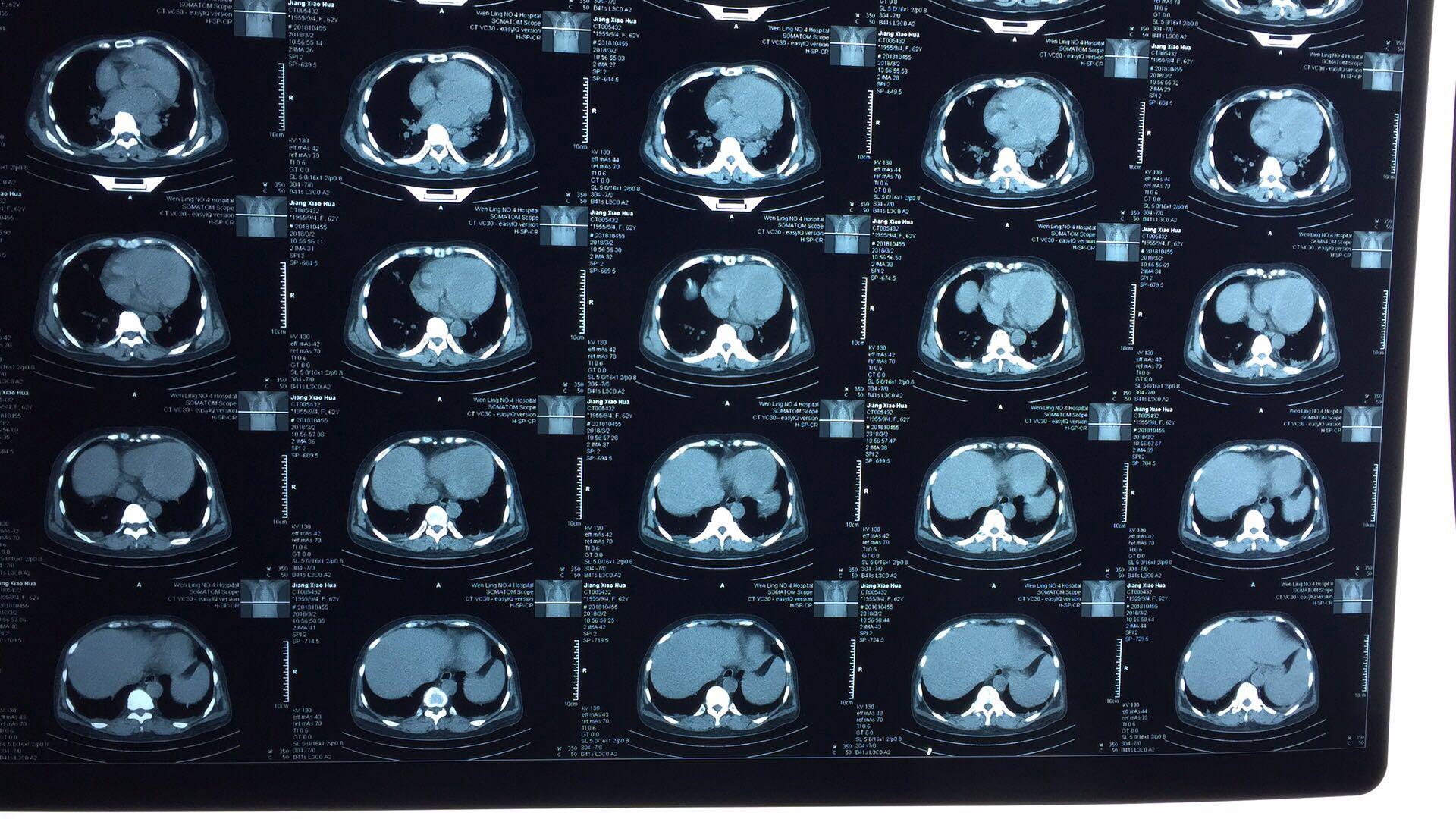 求助ct读片 - 医学影像学讨论版 - 爱爱医医学论坛