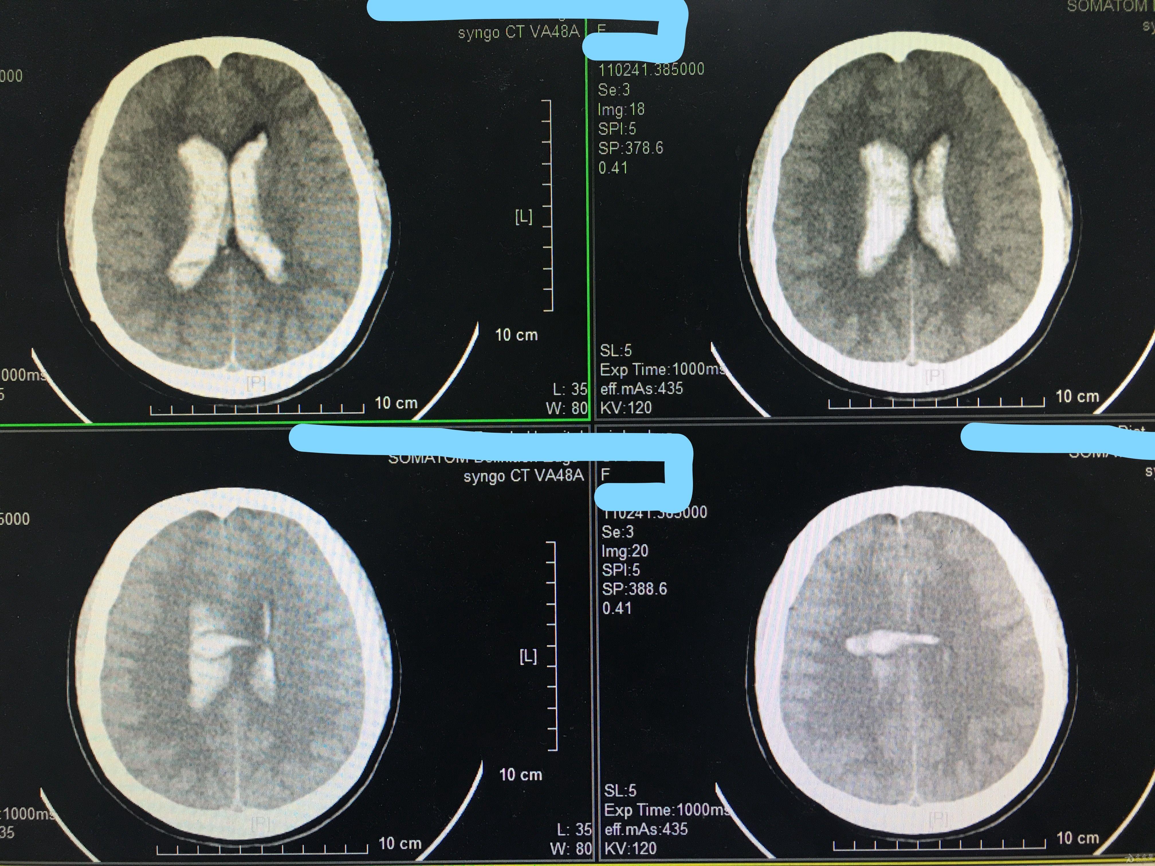 脑室铸型,开颅还是放管?(原创) - 神经外科专业讨论版 - 爱爱医医学论