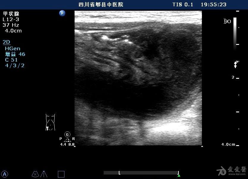 4歲男孩的典型急性化膿性闌尾炎 - 超聲醫學討論版 - 愛愛醫醫學論壇