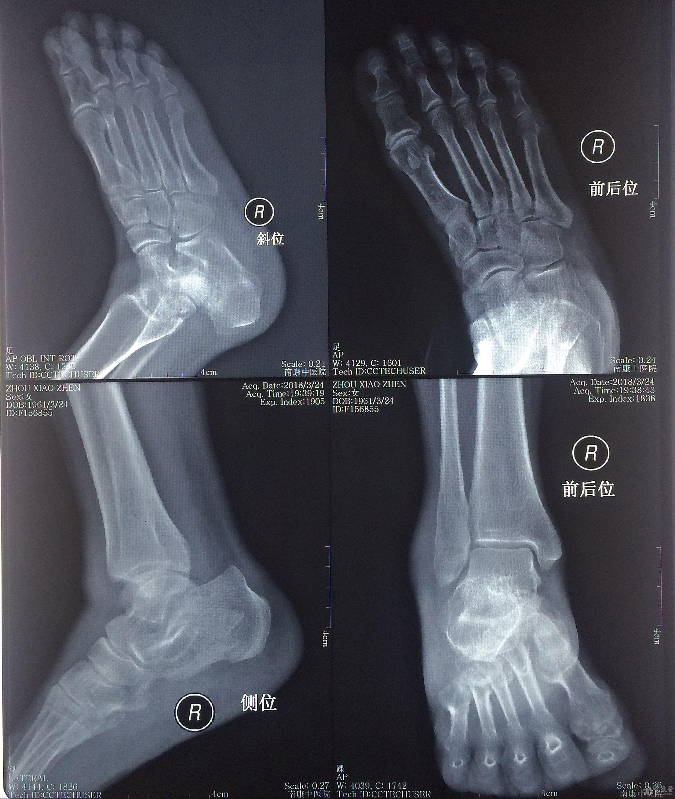 右脚骨裂x光片图片图片