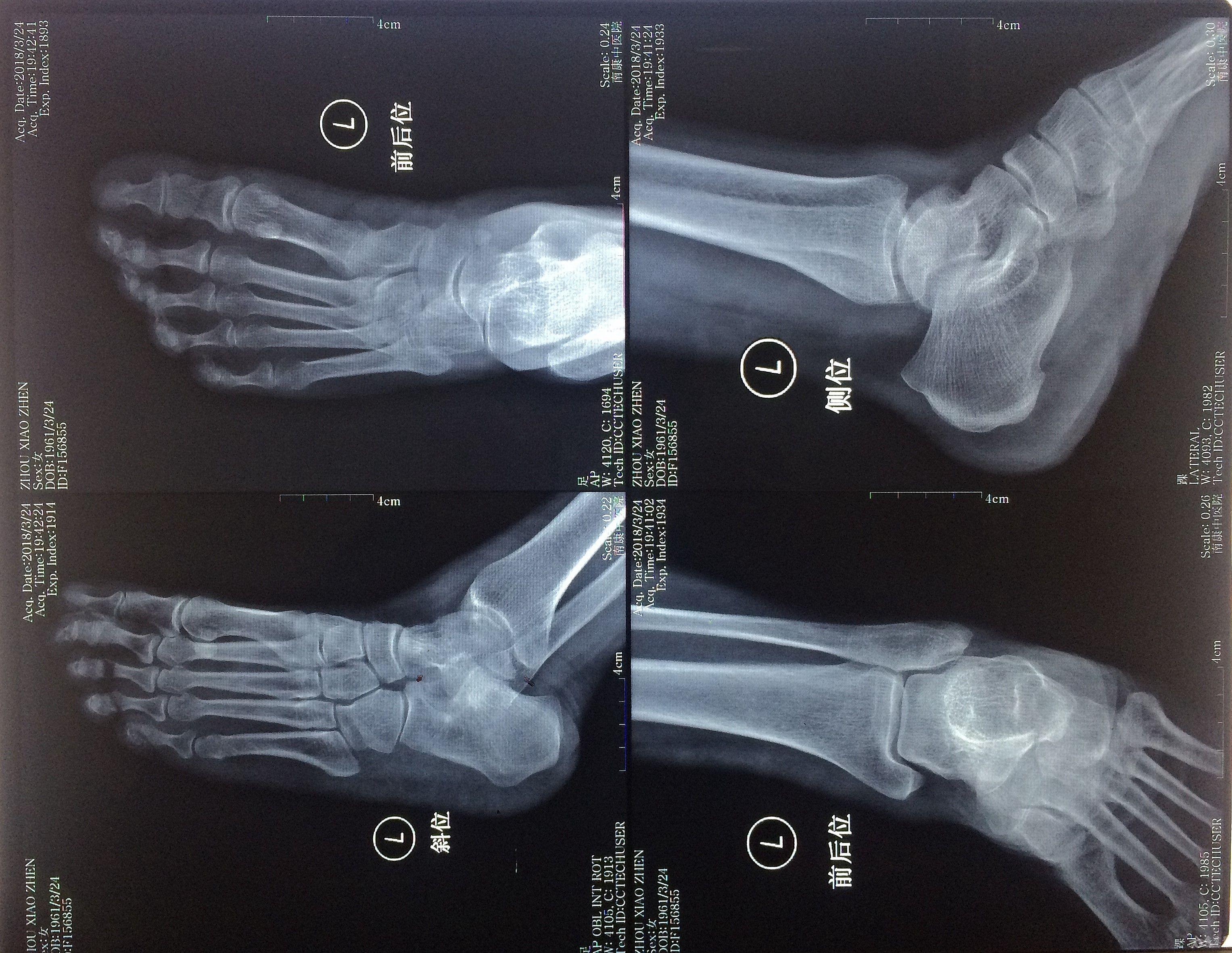 右足第一楔骨骨折图片图片