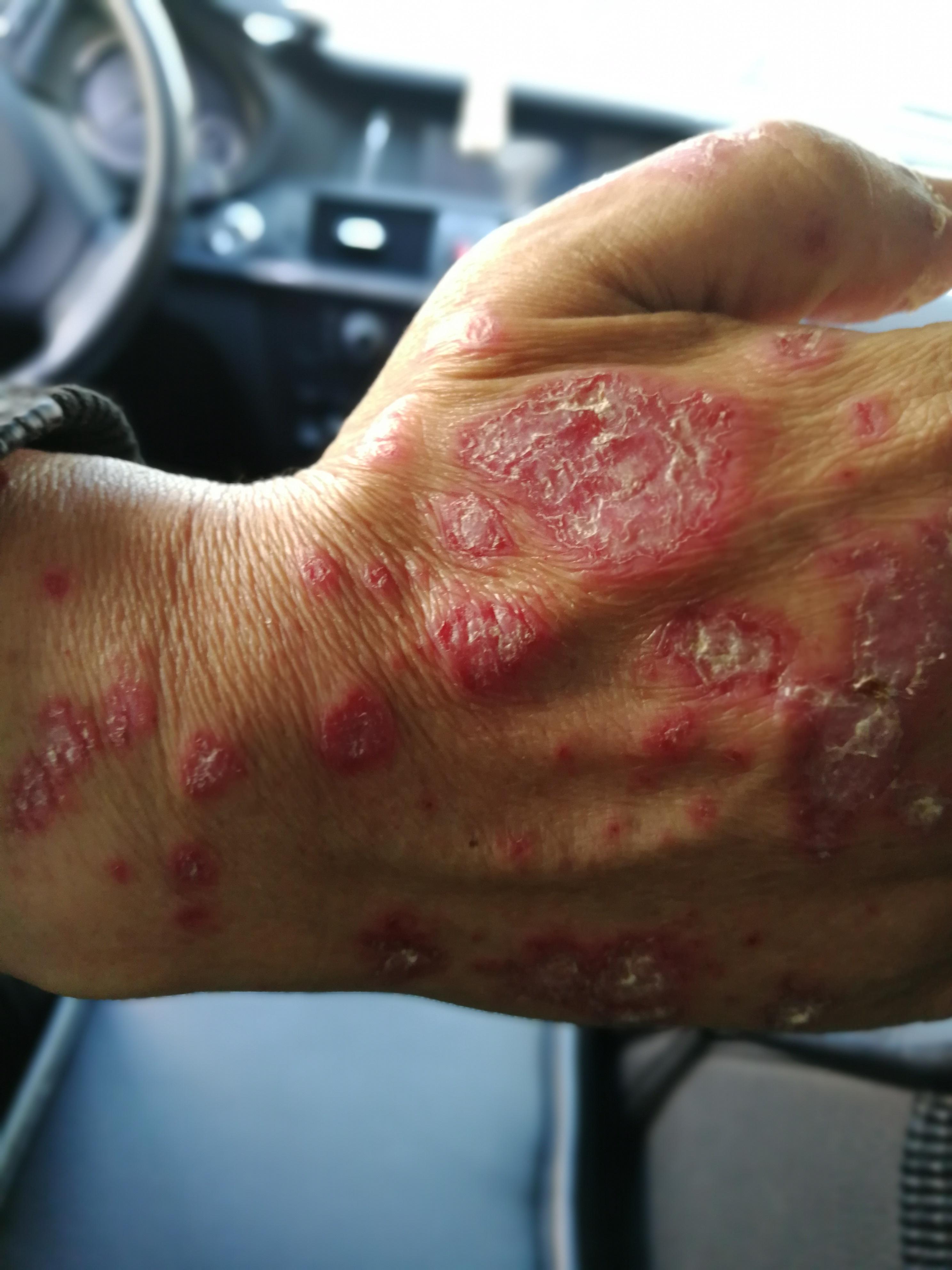 烦请专家看下这是什么皮肤病