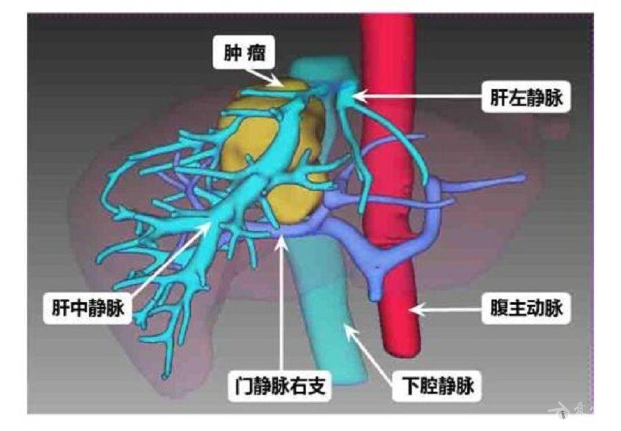 肝脏尾状叶解剖位置特殊,手术几乎涉及肝脏所有的大静脉,术中稍有