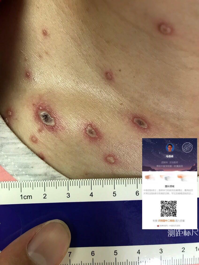 水痘……传染病 - 皮肤及性传播疾病讨论版 - 爱爱医医学论坛