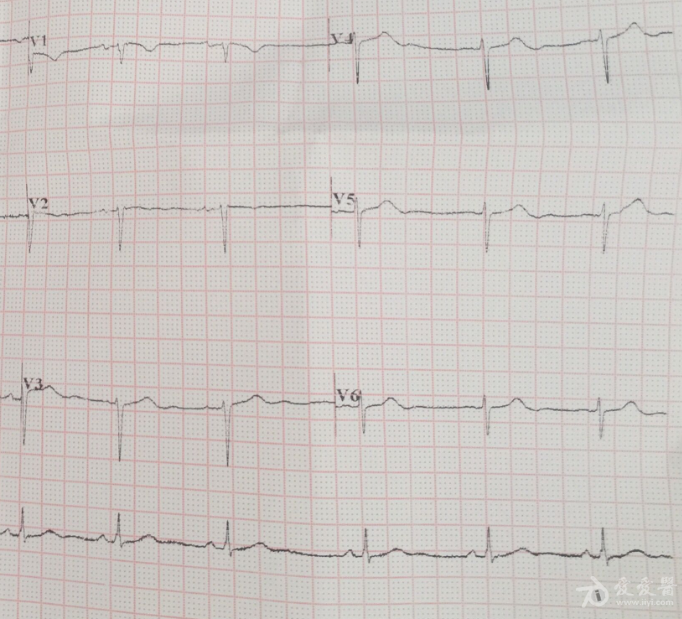 顺钟向转位心电图图片